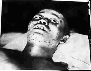Soldier who was exposed to the bomb about 1km from the hypocenter, and showing the acute symptoms such as hair loss, bleeding from the gum and purple spots by hypodermic bleeding. He died shortly after.