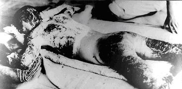A man burned over his entire body; exposed within 1 km of the hypocenter